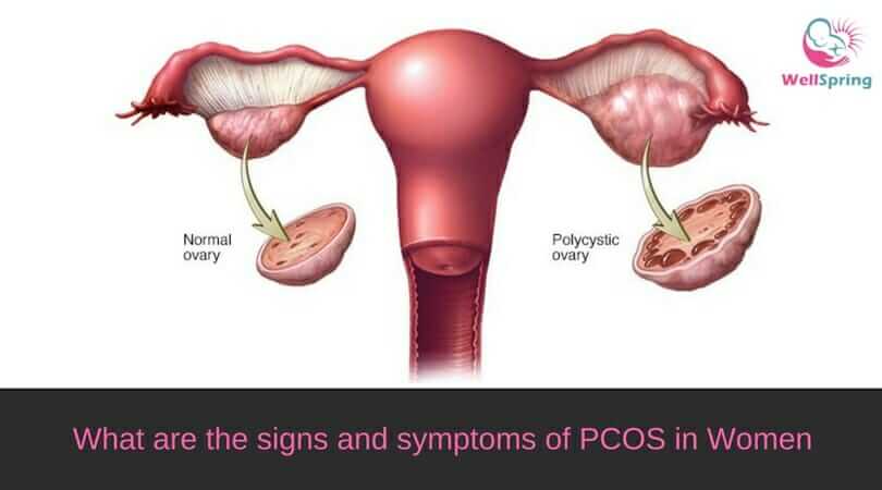 What are the signs and symptoms of PCOS in Women