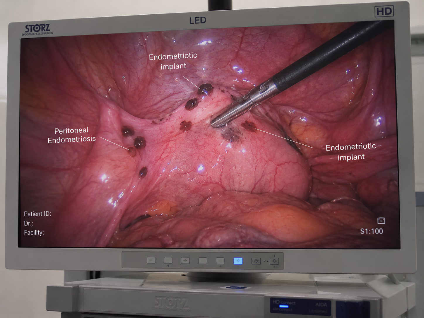 Laparoscopic view of endometriosis lesions and endometriotic implants during minimally invasive fertility-preserving surgery at Wellspring IVF & Women’s Hospital Ahmedabad