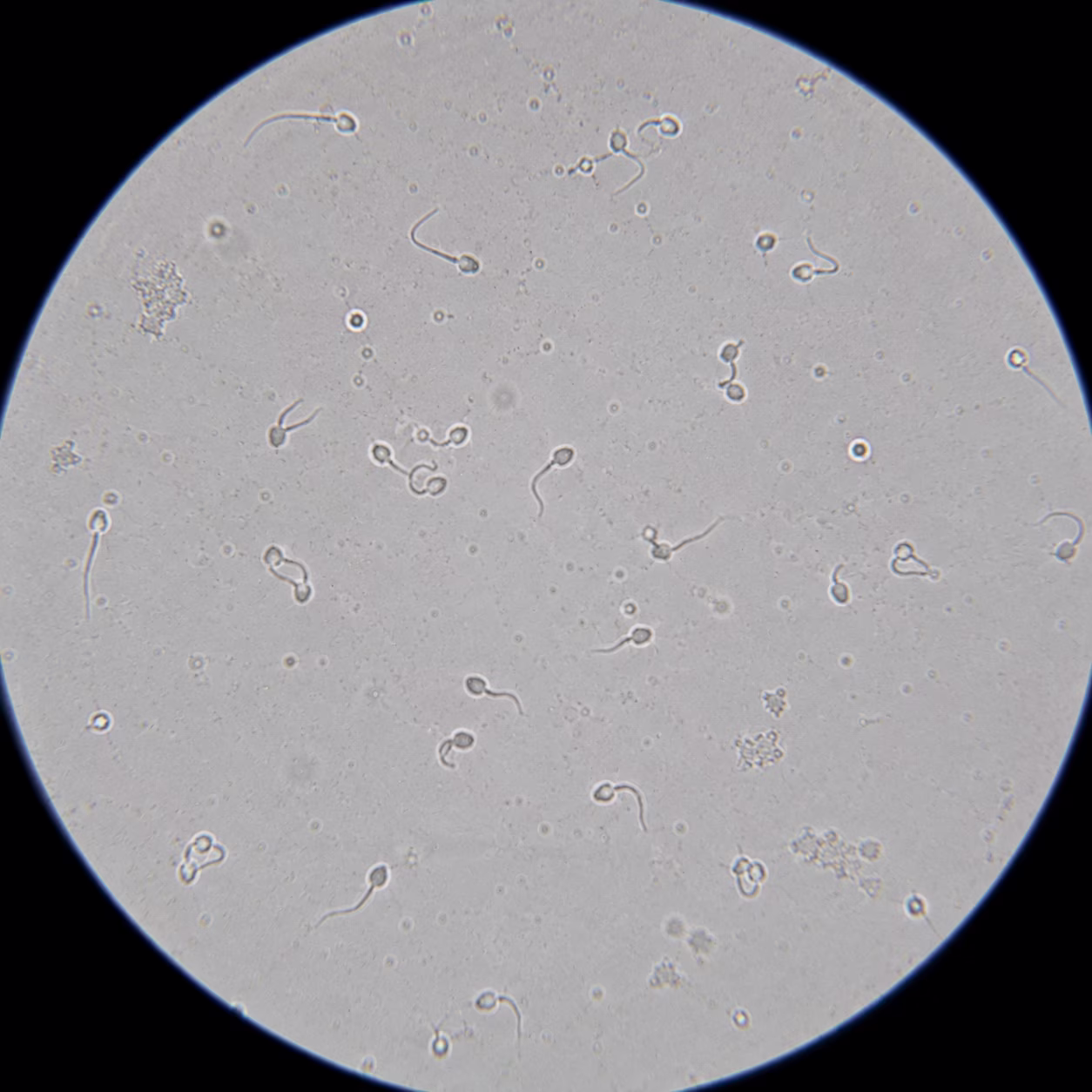 Microscopic semen analysis showing poor sperm motility (asthenozoospermia) with sperm demonstrating reduced forward movement associated with male infertility