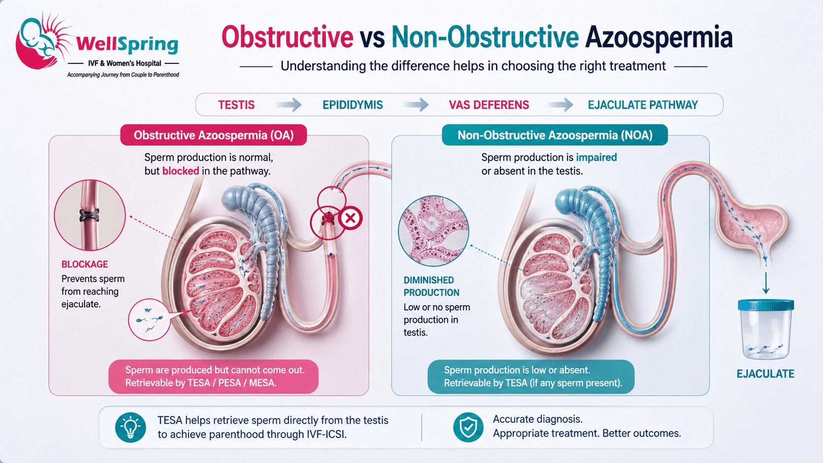Obstructive vs non-obstructive azoospermia comparison — blocked flow vs impaired sperm production.