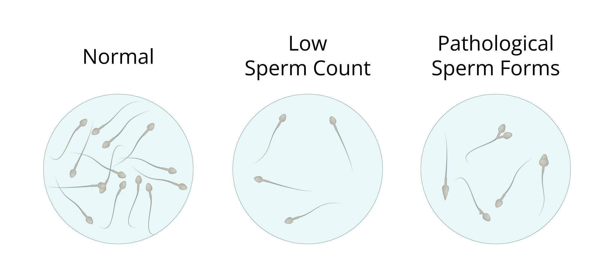 sperm morphology including low sperm count - oligospermia and teratozoospermia on microscopic view